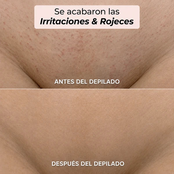 Depiladora Oname® - Olvidate del dolor al depilar