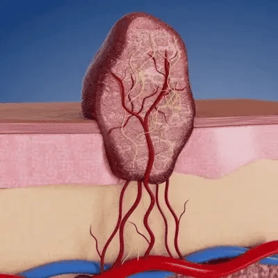 Ohpatch - Patches for Removing Skin Warts