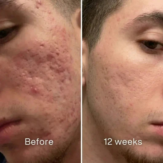 Clinical Acne Scar Repair Stick™
