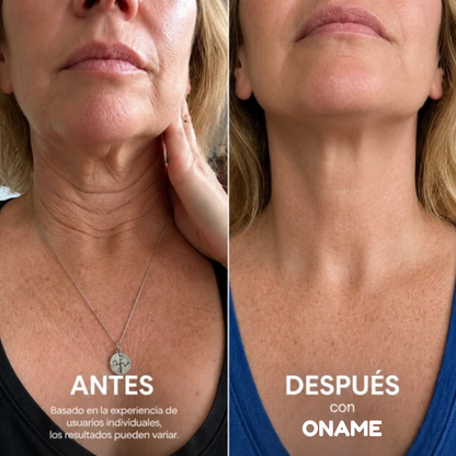 Oname®: Crema para estirar y levantar el cuello