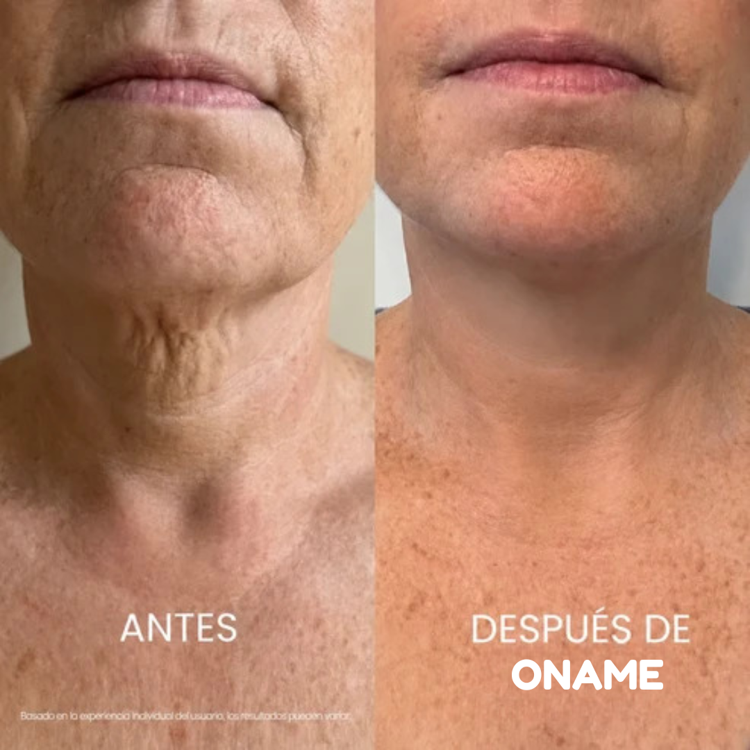 Oname®: Crema para estirar y levantar el cuello