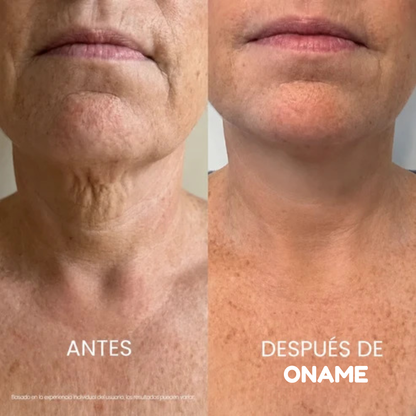 Oname®: Crema para estirar y levantar el cuello