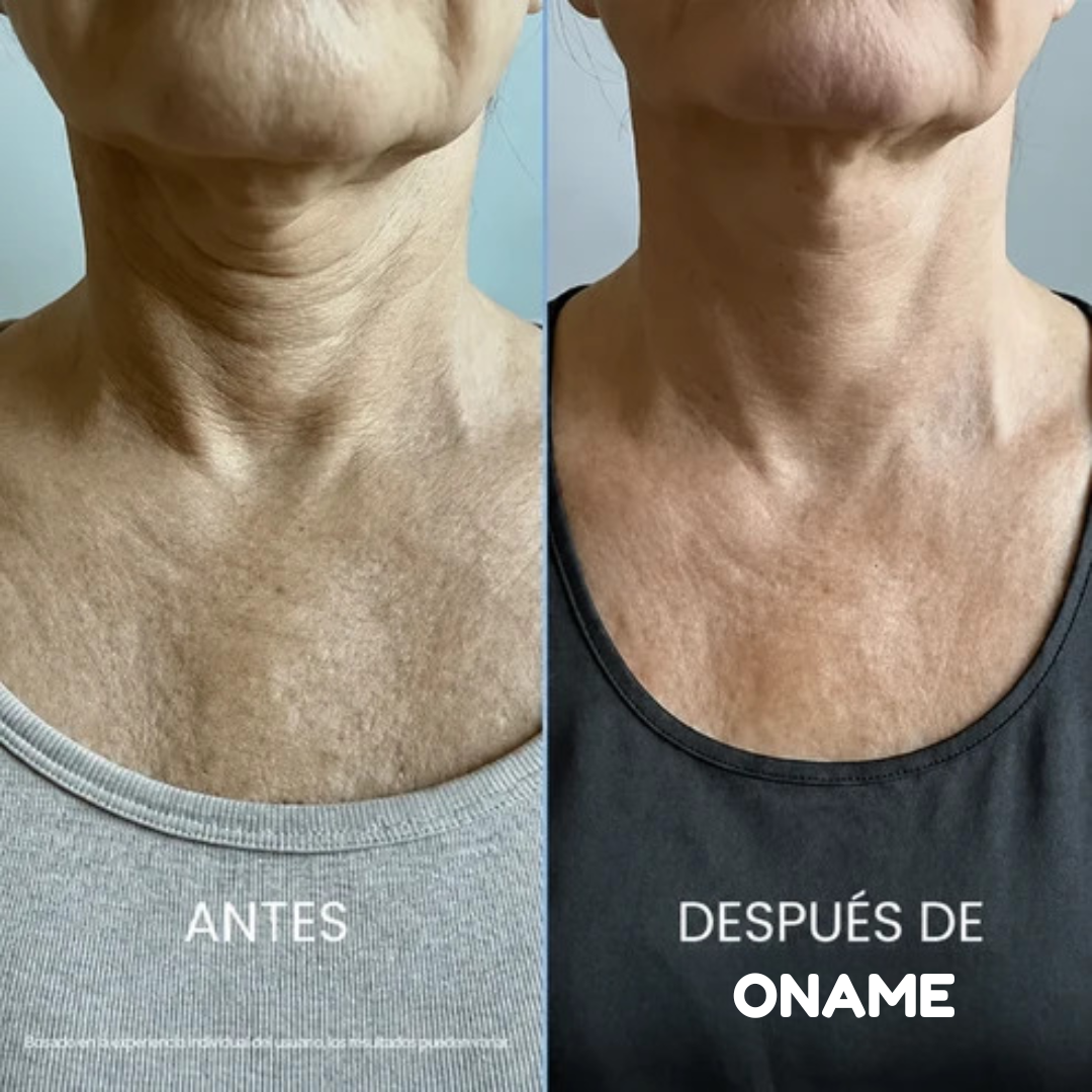 Oname®: Crema para estirar y levantar el cuello