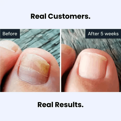 CLINQ Labs Antifungal Pen