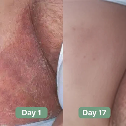 Oname Antifungal Soap®