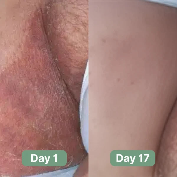 Oname Antifungal Soap®